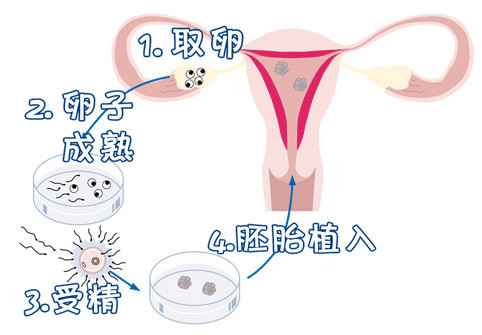 ICSI操作